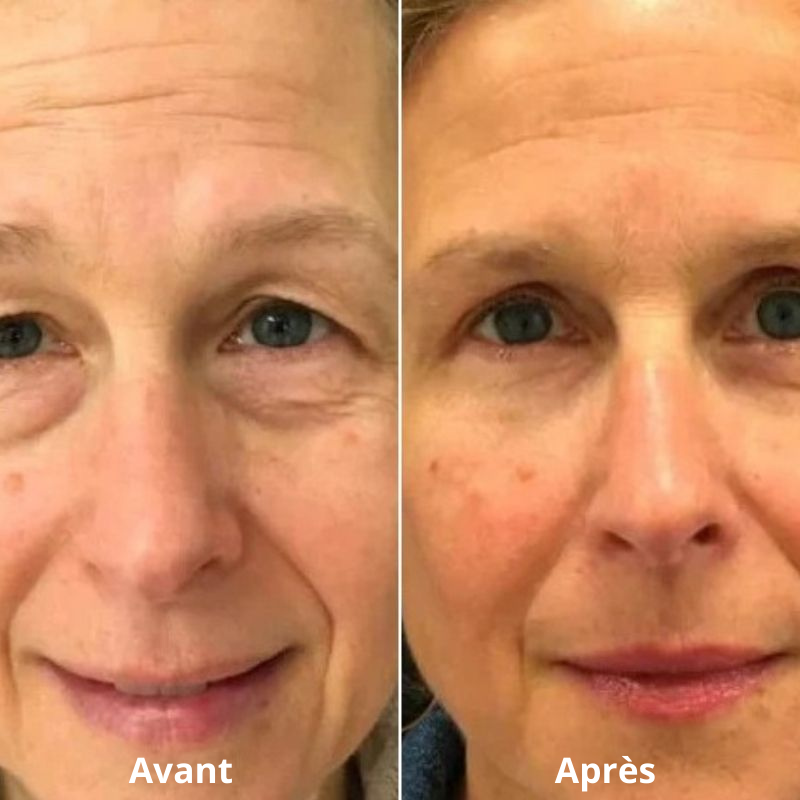 LUMILIFT®  Innovation anti-poches et cernes