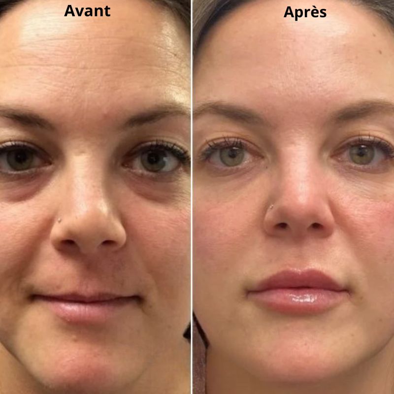 Patchs Hydralift (8 paires)